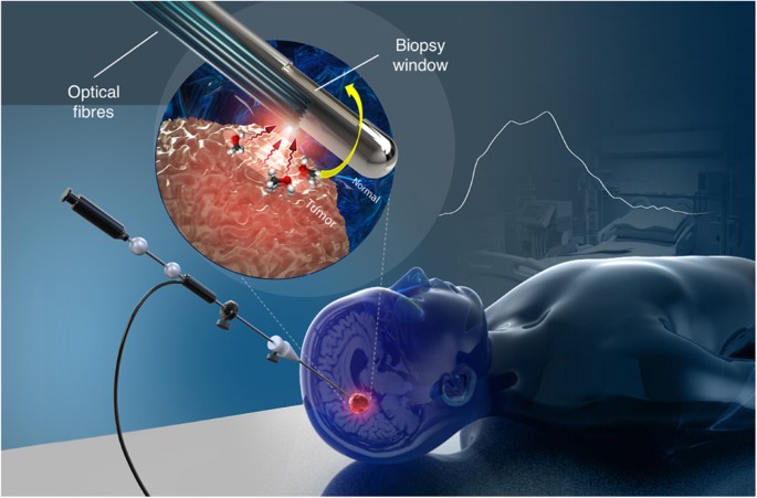 Belay Diagnostics Validates New MGMT Test for Brain Cancer Detection