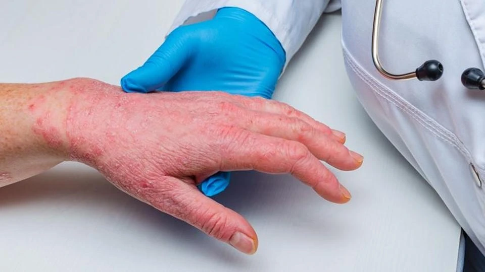 Leo Pharma's New Scientific Data to Cure Chronic Hand Eczema (CHE)